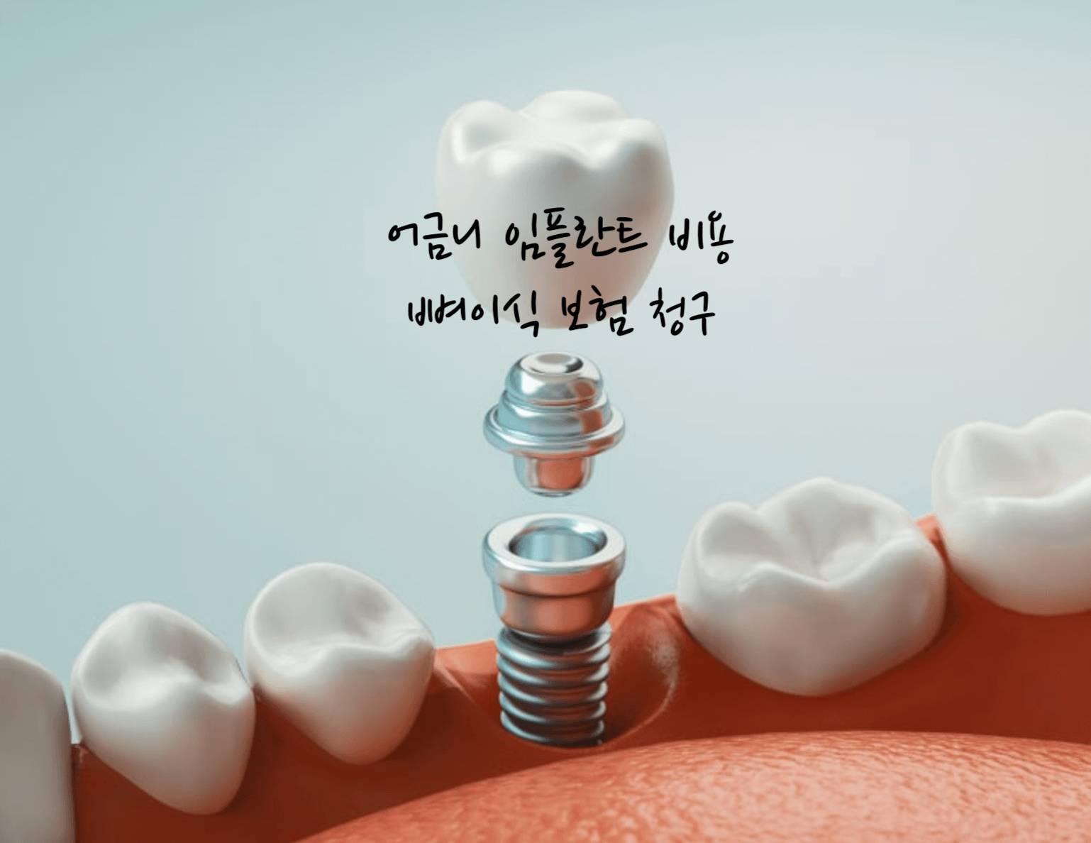 어금니 임플란트