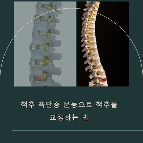 척추측만증 교정운동