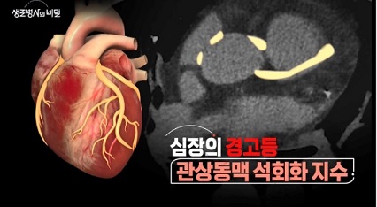 관상동맥