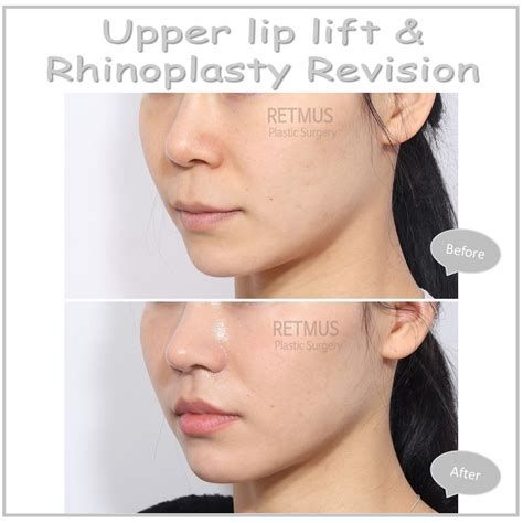 인중 축소 수술