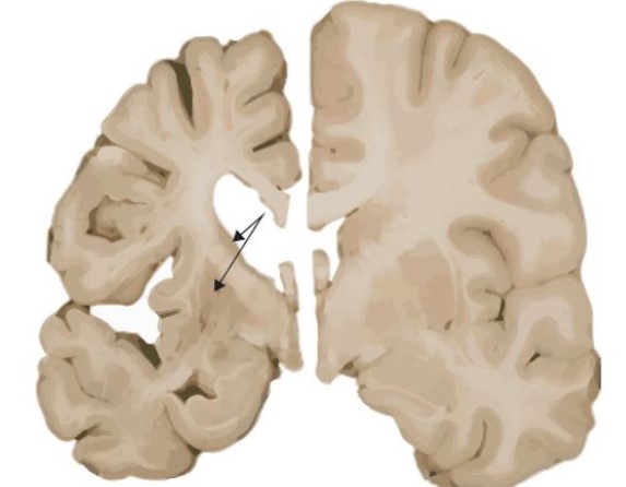 헌팅턴병 원인 증상 치료법
