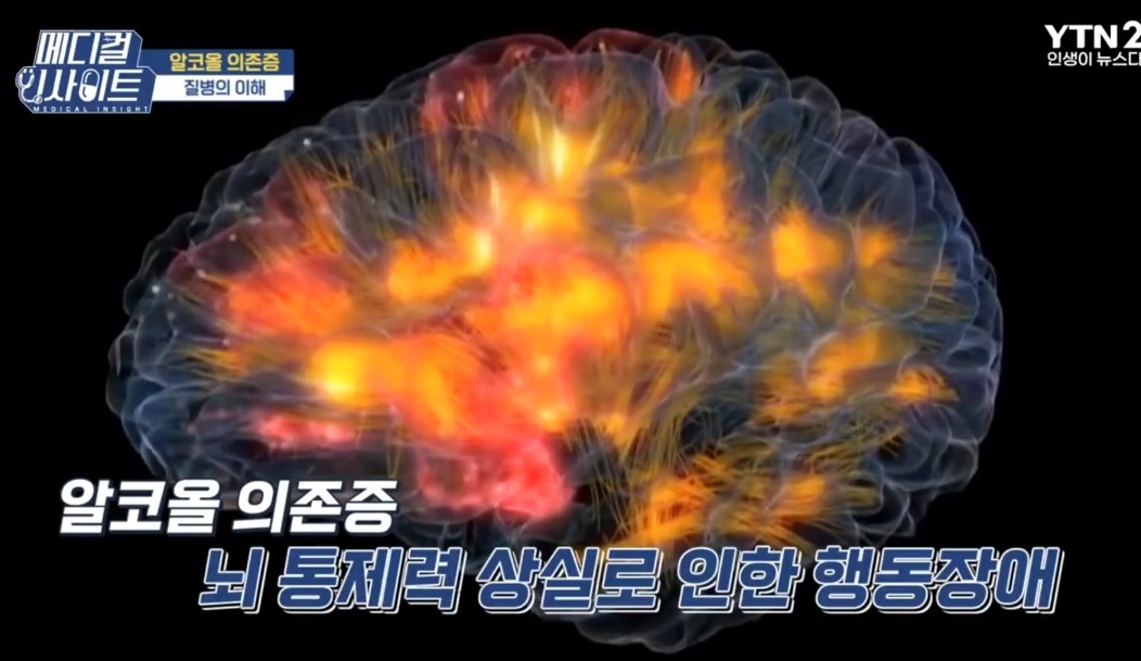 노성원-교수-알콜성치매