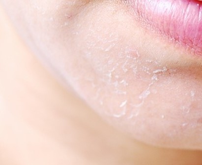 환절기 피부 각질