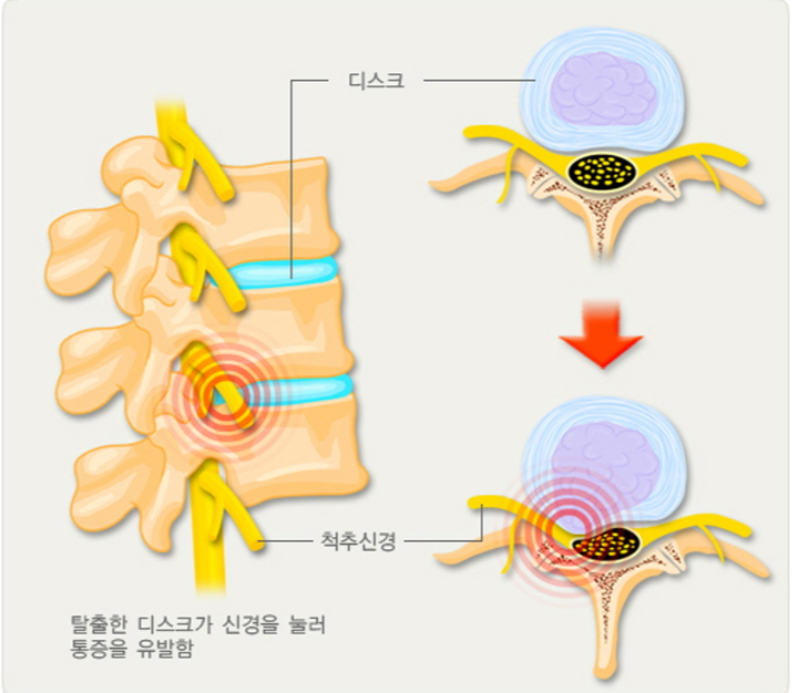 목디스크 증상