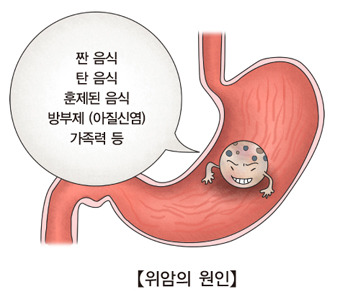 위암 원인부터 초기증상·치료·예방까지