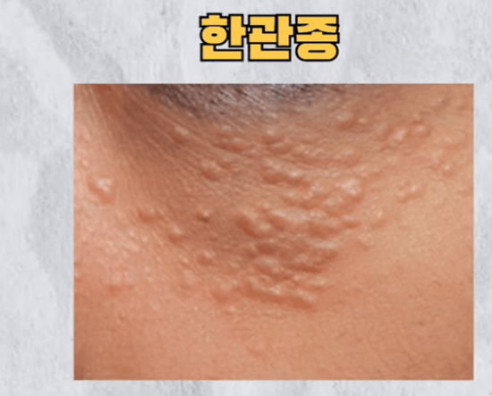 눈밑에 하얀 좁쌀