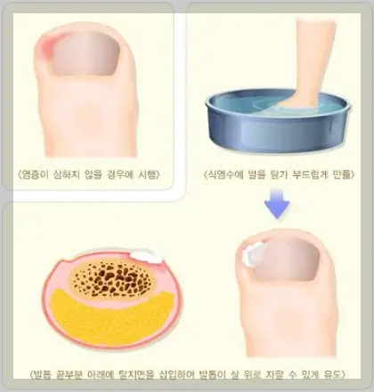 내성발톱 자가치료