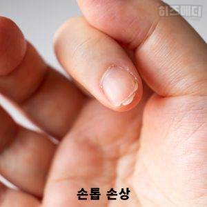 수족구 증상