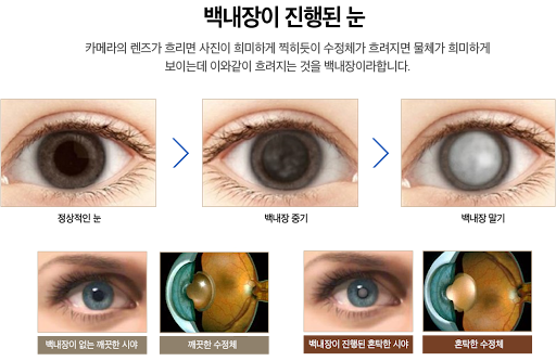 백내장이 진행된 눈