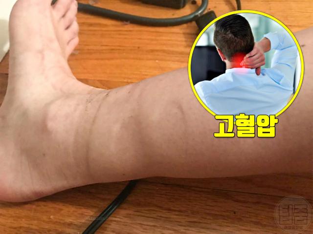 다리 양말자국 질환 코끼리다리 무다리 원인 고혈압