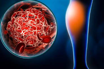 종아리 혈액순환