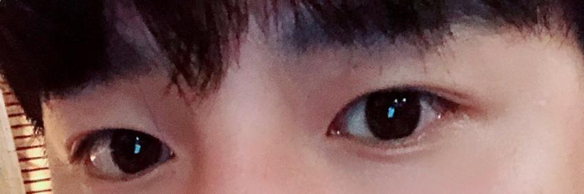 안검하수 후기