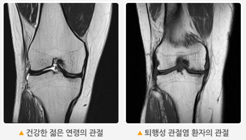 퇴행성 관절염 환자의 관절