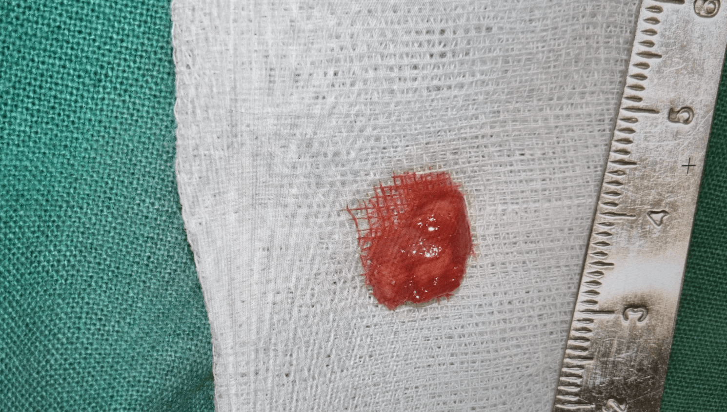 치아 염증 제거