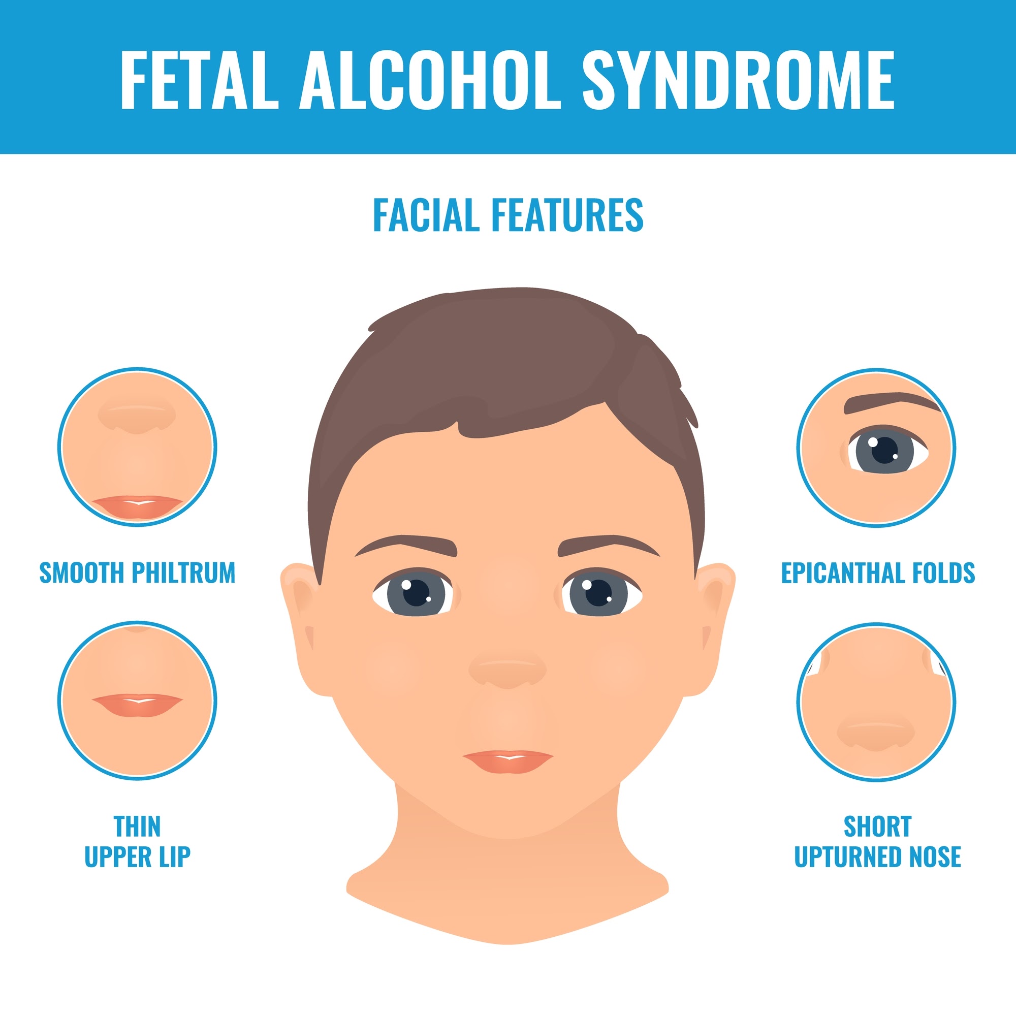 태아 알코올 증후군
