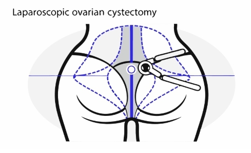 난소낭종 수술 과정