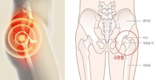 고관절 통증 7일 완화 루틴