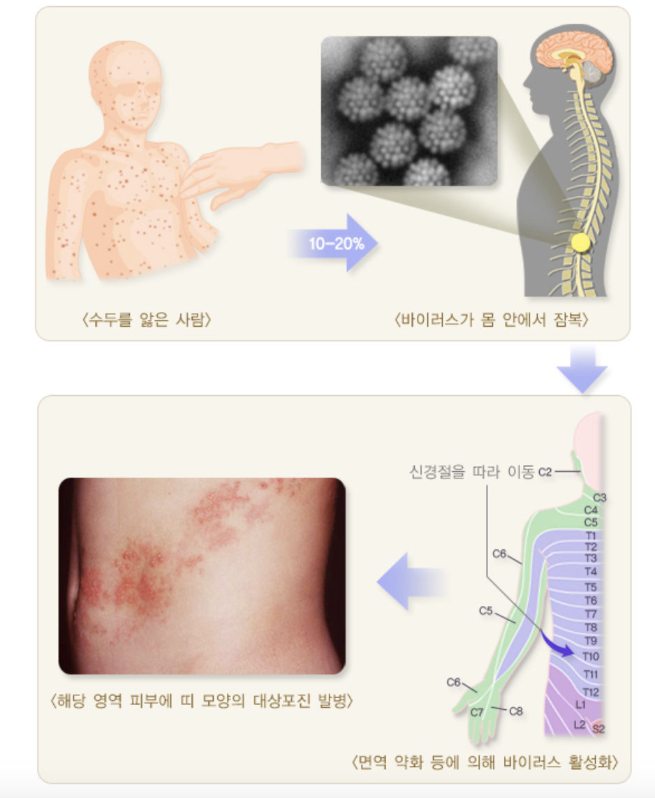 수두와 대상포진