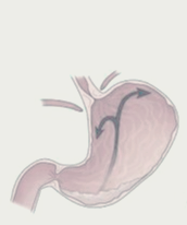 역류성 식도염 증상