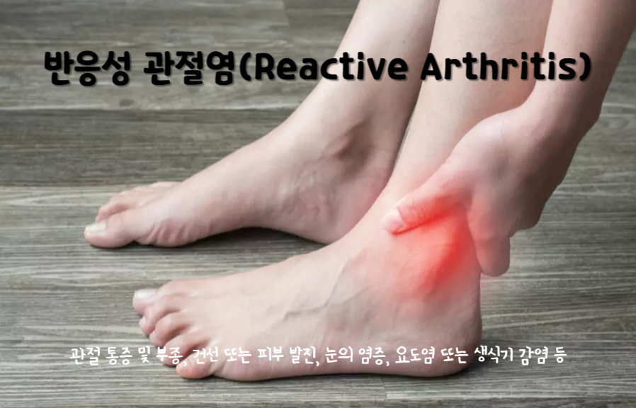 반응성 관절염(Reactive Arthritis)
반응성 관절염의 주요 증상 : 관절 통증 및 부종, 건선 또는 피부 발진, 눈의 염증, 요도염 또는 생식기 감염 등