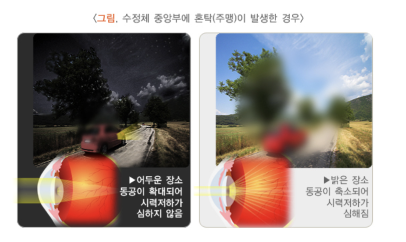 수정체 중앙부에 혼탁 발생하는 경우