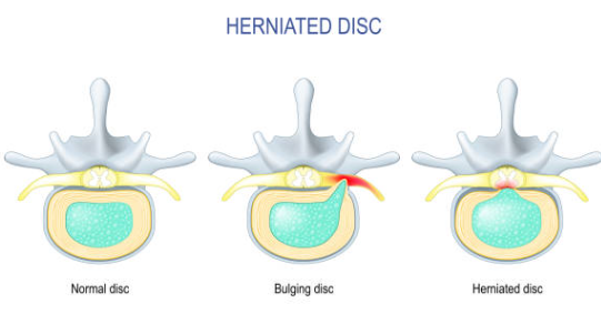 허리 디스크 단계