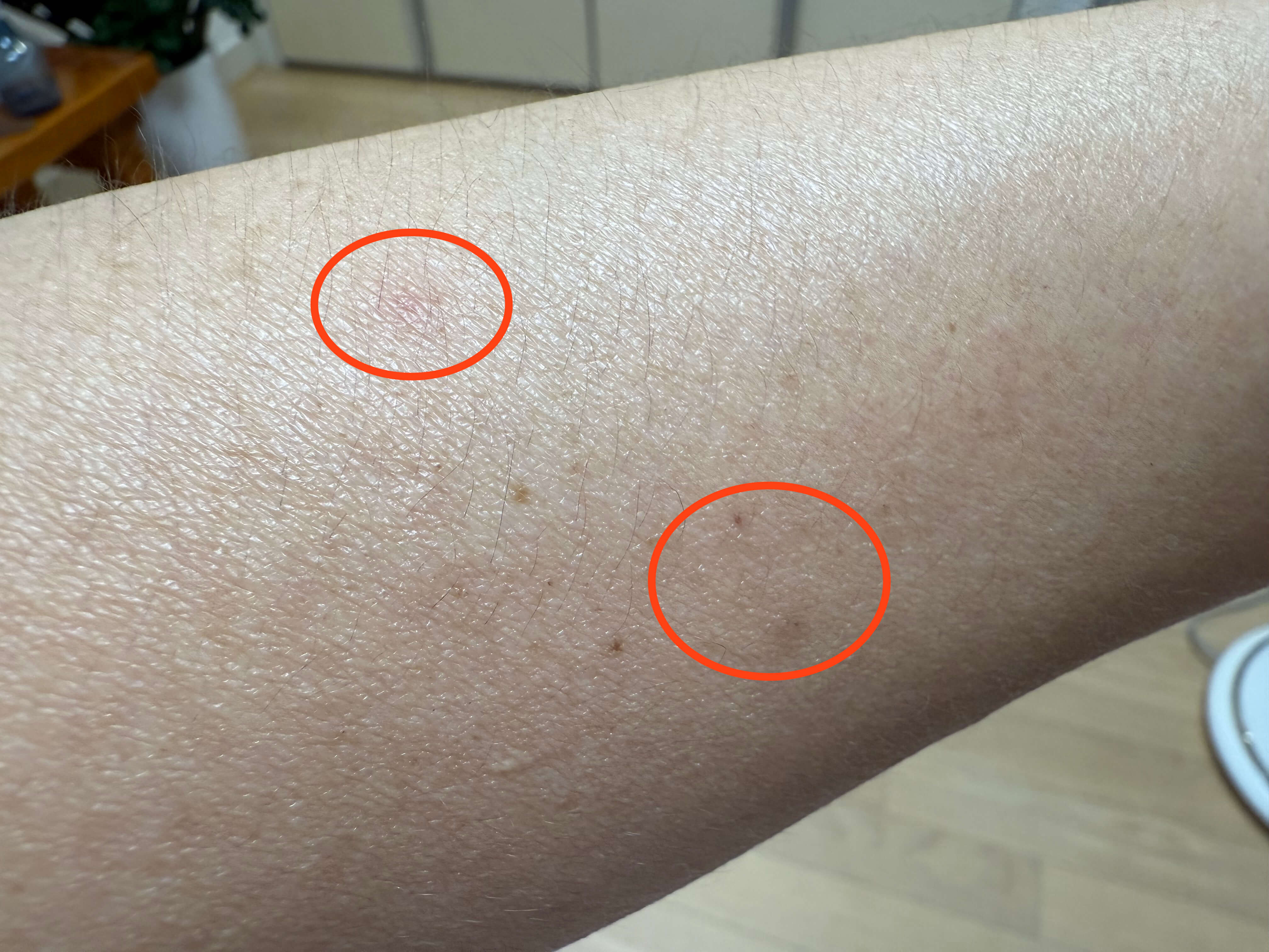 권연벌레 물린 자국