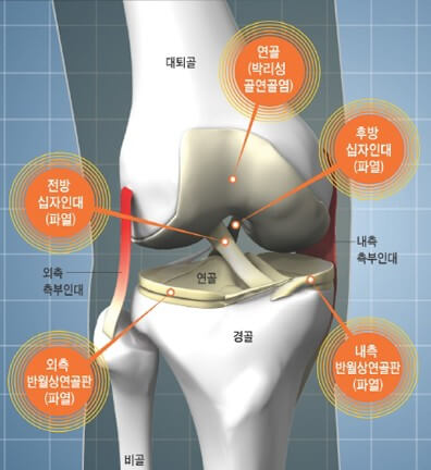 관절 부상