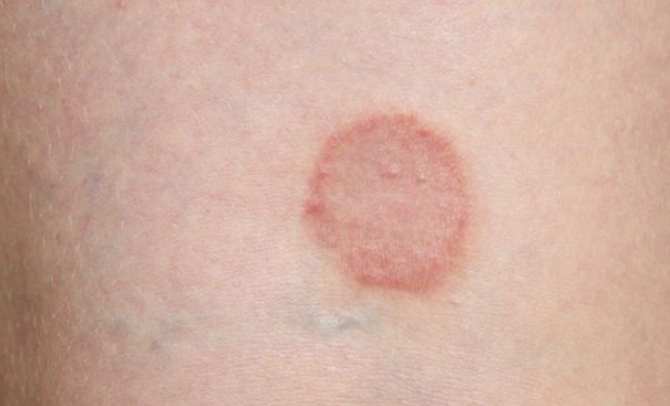 대상포진-옮나요