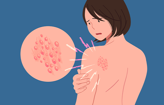 대상포진 증상 수포