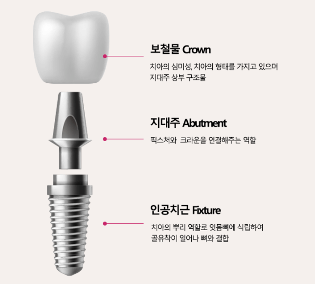 임플란트 구조