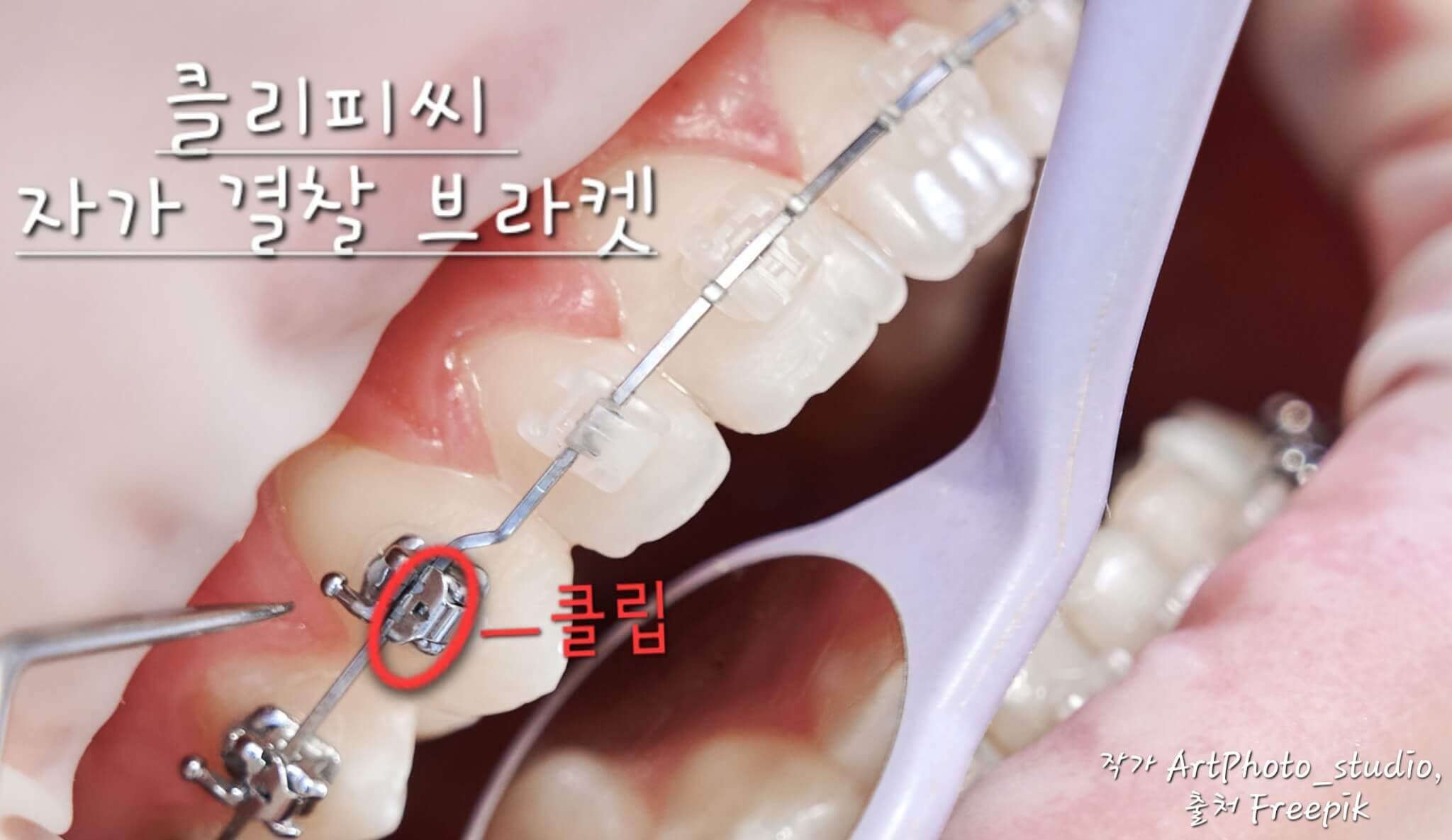클리피시브라켓