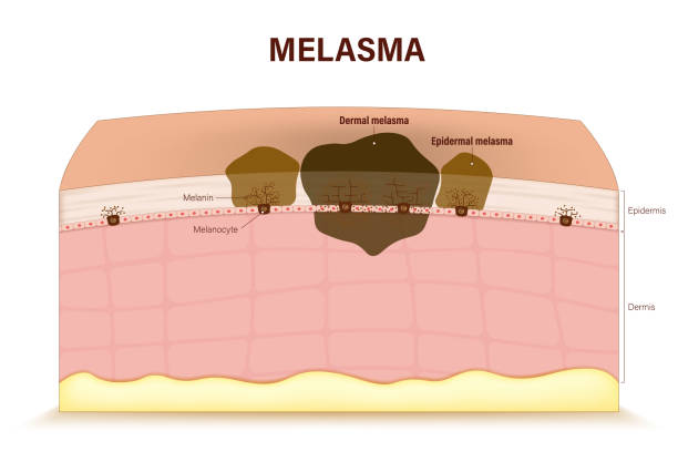 검버섯 기미 차이 없애는 방법 법 레이저 연고 박피 크림