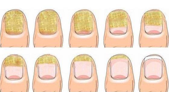 발톱무좀 증상 (사진출처 : Pinterest)