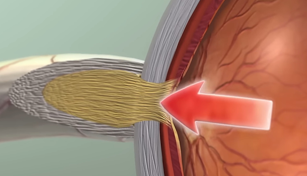 녹내장 초기증상