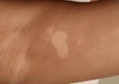 백반증 초기증상 31