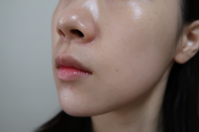 bbl 레이저 후기