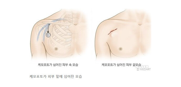 케모포트, 히크만 카테터 삽입 및 주의사항, 이를 중심정맥카테터라고 말하는데 여러가지 암이 발생했을 때 사용하는 기구를 말합니다. 항암화학요법을 할 때 주사로 된 약이 투여되는데 필요합니다. 케모포트와 히크만카테터에 대해 참고하시기 바랍니다.