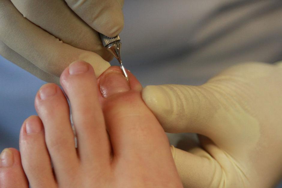 toenail