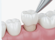 크라운치료-사진9