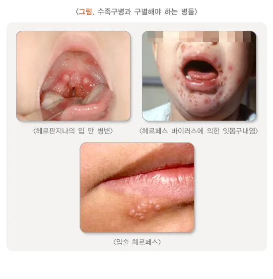 수족구 초기 증상 어른 감염 격리기간 예방 치료 완전 가이드_3