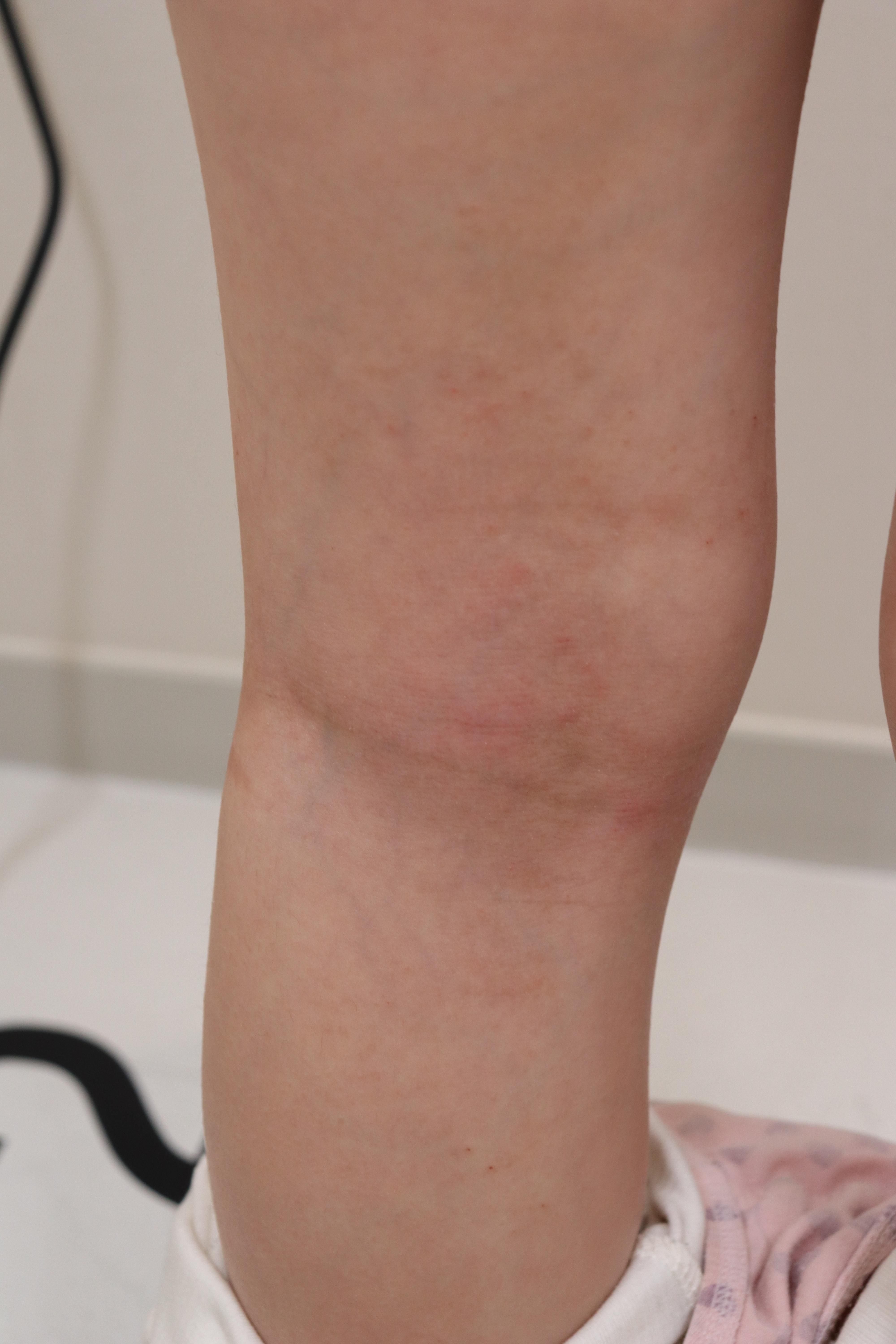 피부과 간지럼증 가려움증 치료방법