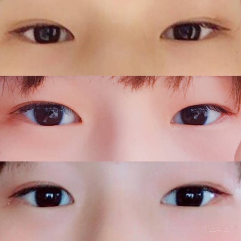 안검내반수술 후기