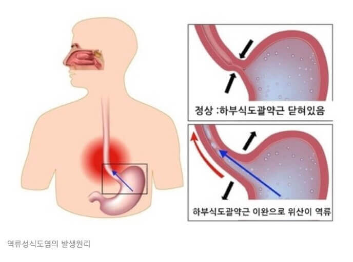 역류성 식도염의 발생 원리