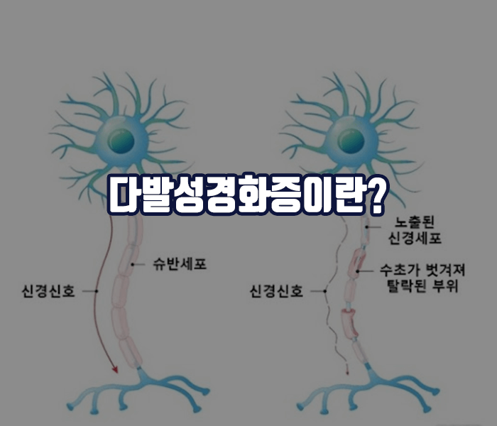 다발성경화증이란