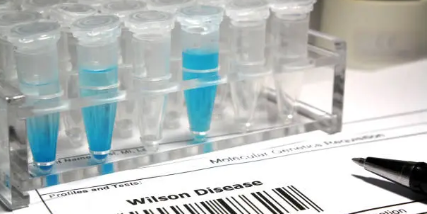 윌슨병