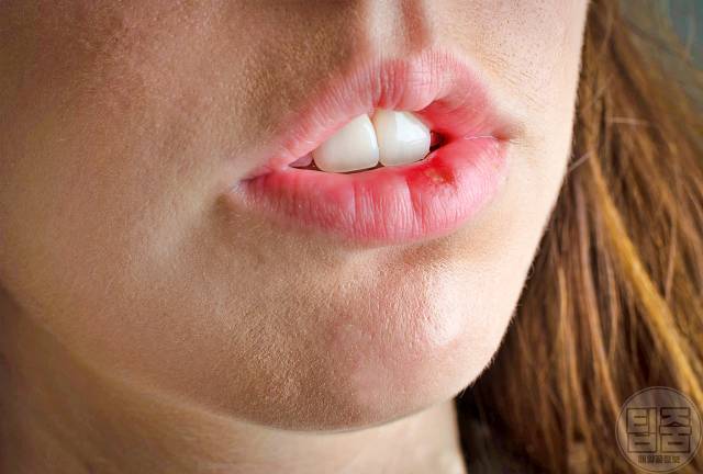 엽산 부족 증상 엽산효능 구순염