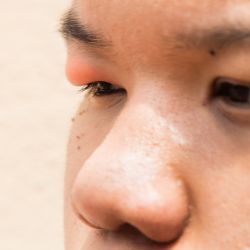 눈 다래끼-사진-4