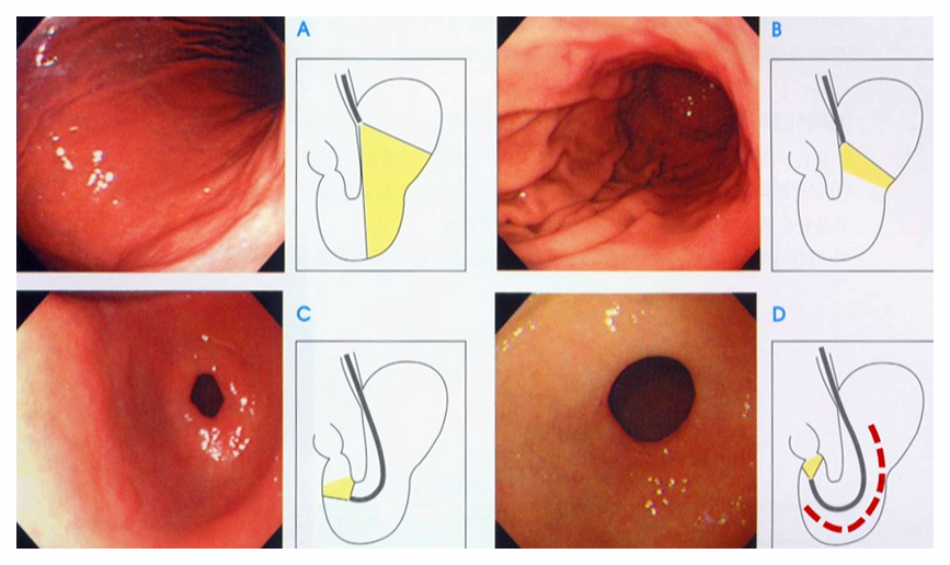 위내시경-금식시간