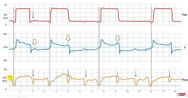 ineffective trigger ventilator graph